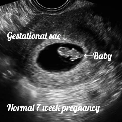 how accurate is ultrasound dating at 6 weeks